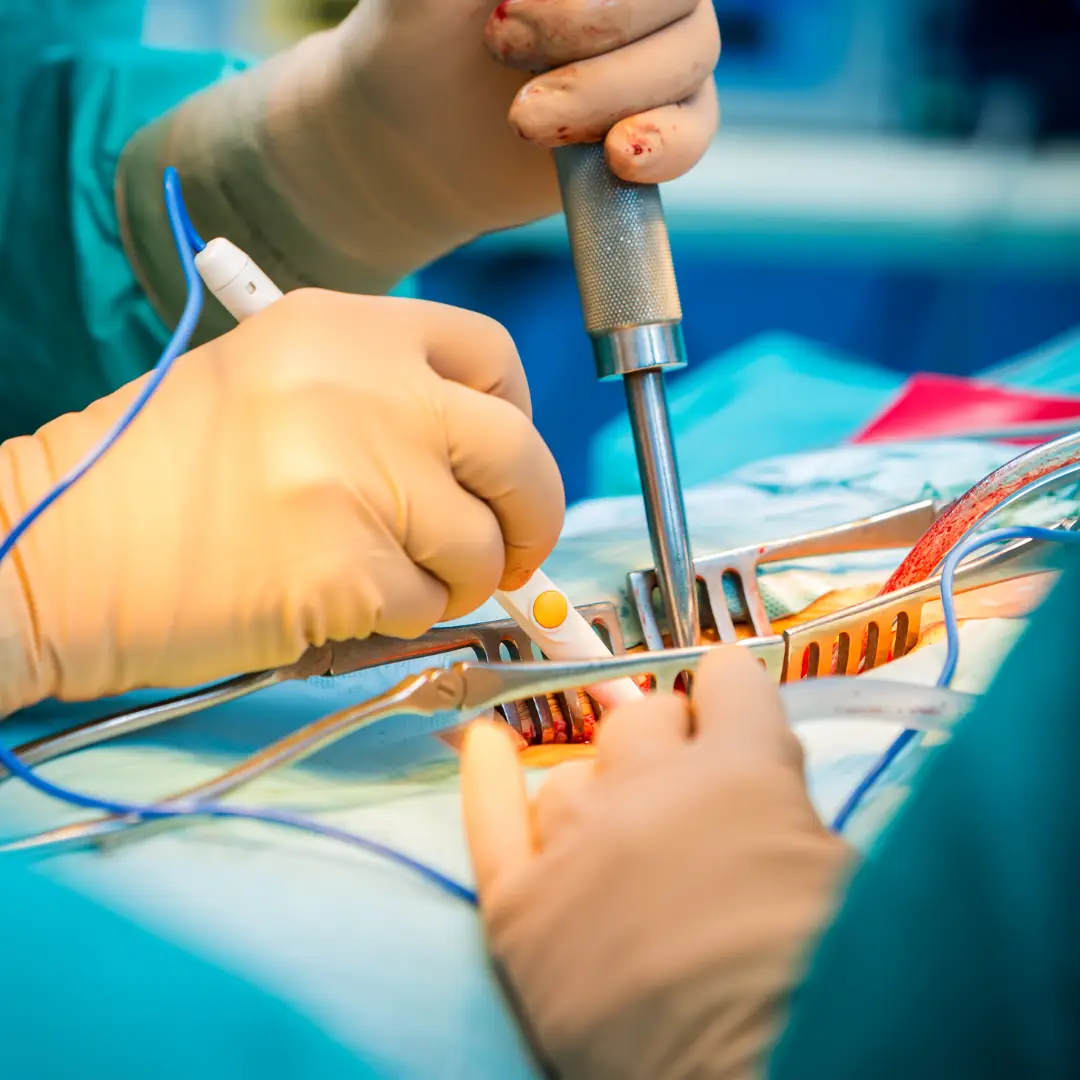 Spine Surgery Vadodara